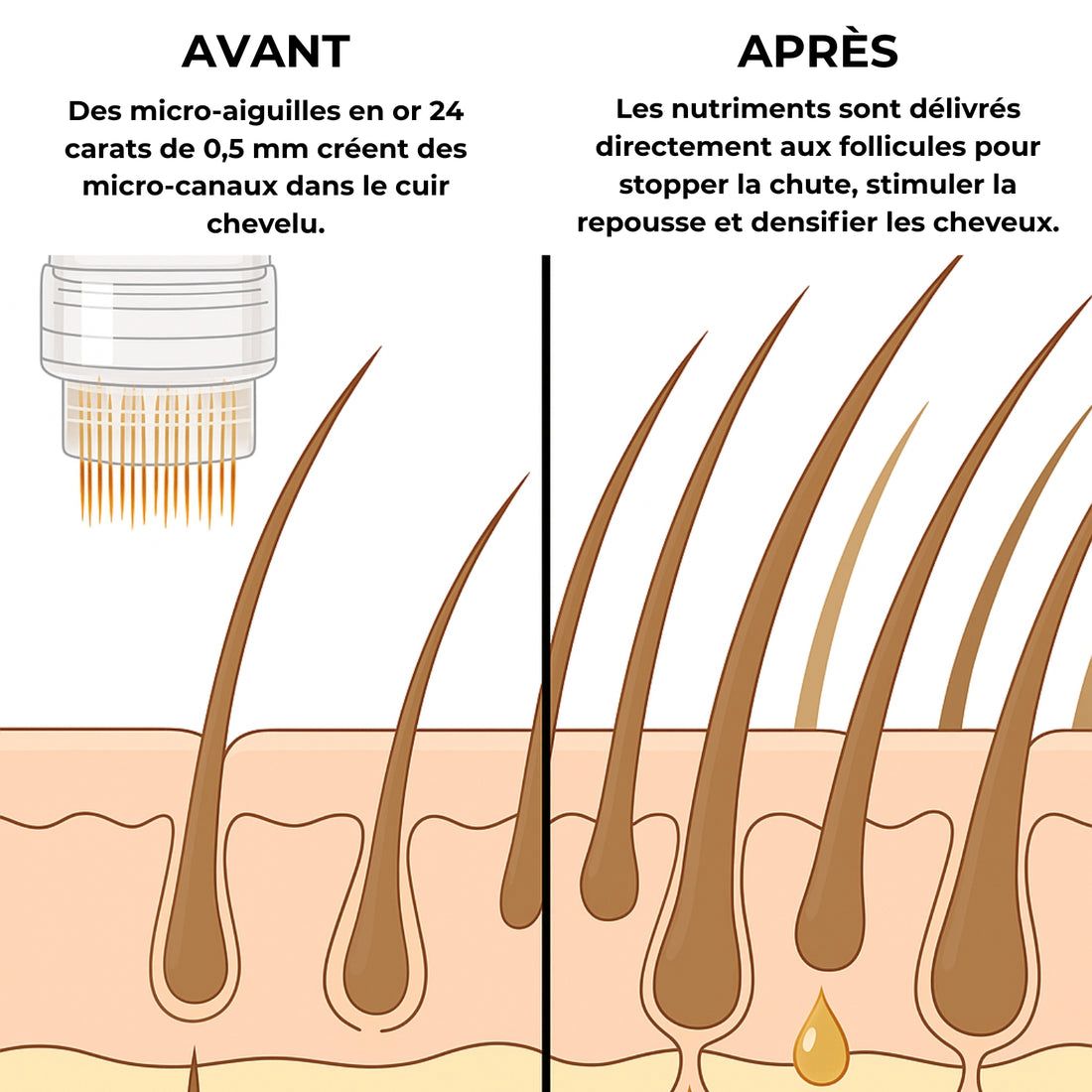 Infusion capillaire NOVA INFUSE