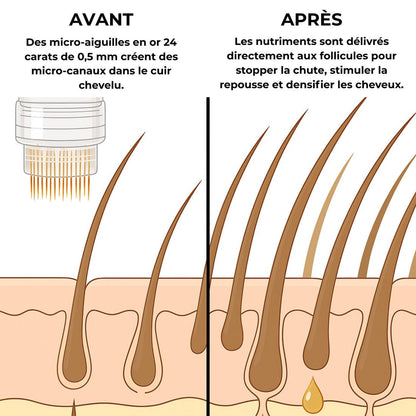 Infusion capillaire NOVA INFUSE